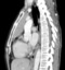 Axial and sagital reconstruction from a contrast enhanced chest CT at the level of the ascending aorta demonstrates an anterior medastinal mass. The mass shows a small regions of heterogeneity with a low attenuation region, and abuts the anterior aspect of the pericardium. There is a lobulated contour that abuts the lung . At surgery, the thymoma was found to invade the medaistinal fat as well as the right lung, without invasion into the aorta or other mediastinal vessels .